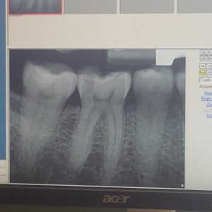 my broken tooth